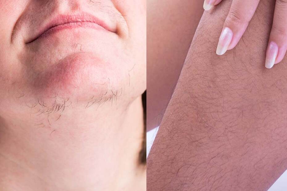 Facial Hair Removal Solutions for face and body